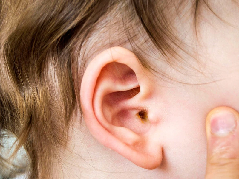 Bật mí các cách chữa viêm tai giữa bằng lá mơ lông hiệu quả 1