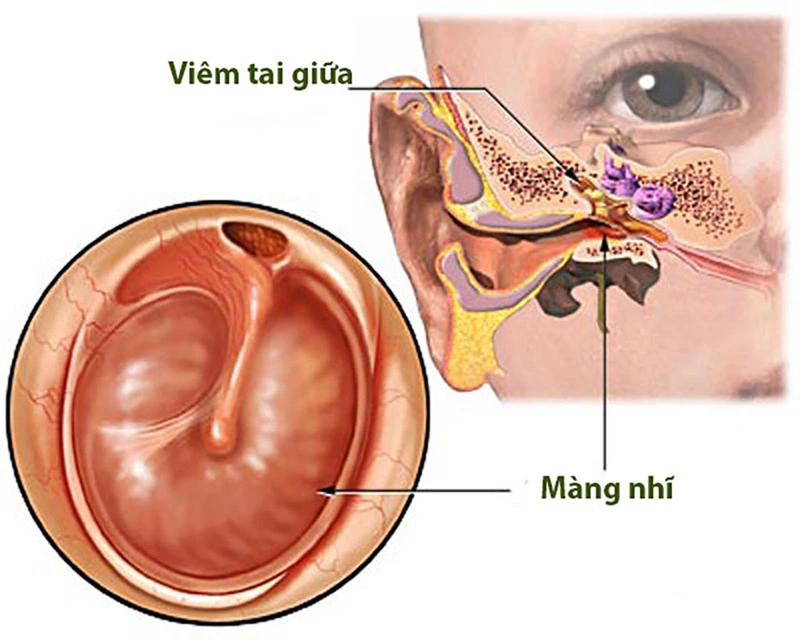 Viêm tai giữa là gì? Kháng sinh điều trị viêm tai giữa1