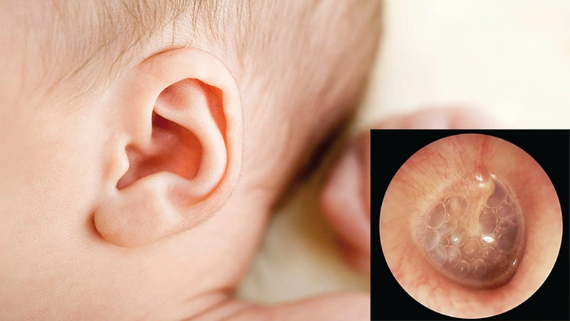 Viêm tai giữa ứ dịch ở trẻ