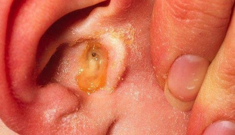 Chảy mủ tai ở trẻ em và những điều ba mẹ cần biết 1