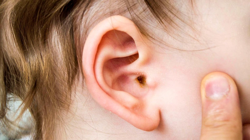 Viêm tai ngoài ở trẻ sơ sinh và những điều cần biết1