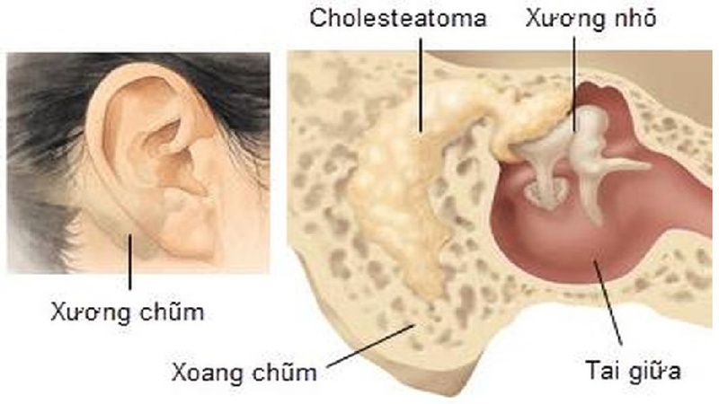 Viêm tai xương chũm cấp có thể gây tổn thương sọ