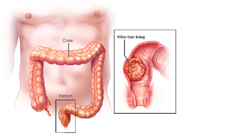 Viêm trực tràng hậu môn có nguy hiểm hay không 1