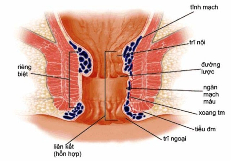 Viêm trực tràng hậu môn có nguy hiểm hay không 2