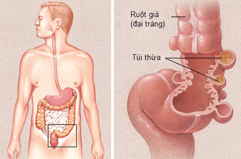 Viêm túi thừa đại tràng phải có nguy hiểm đến tính mạng hay không1