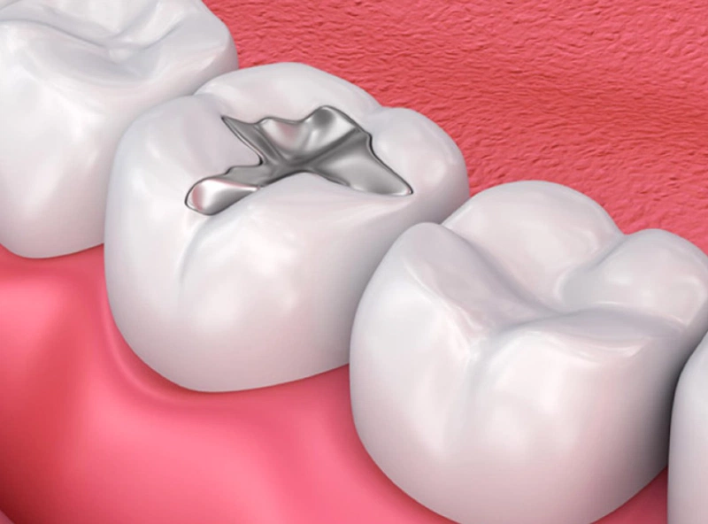 ​Viêm tủy răng có hồi phục​ là gì và điều trị được không