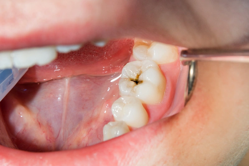 Viêm tủy răng có nguy hiểm không (Ảnh 2)