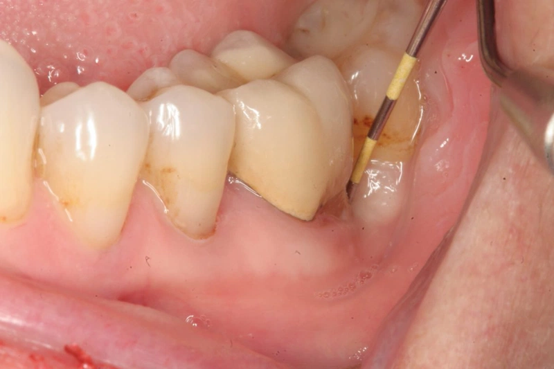 Viêm tủy răng không hồi phục là tình trạng viêm tuỷ đặc biệt nguy hiểm