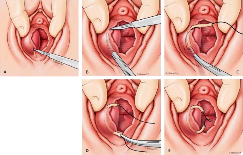 Viêm tuyến Bartholin có nguy hiểm không? Điều trị như thế nào? - Nhà thuốc FPT Long Châu