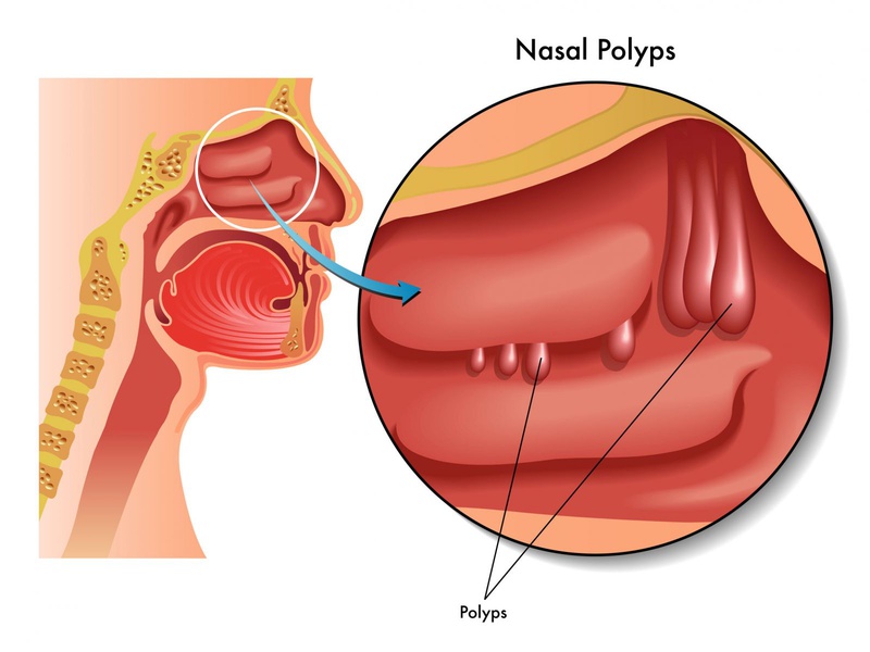 Viêm xoang Polyp mũi điều trị thế nào? 1