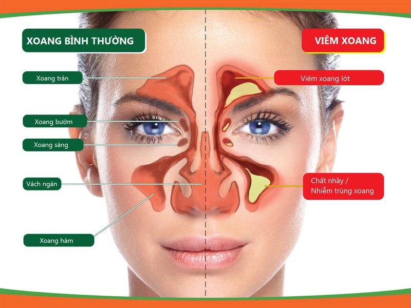 Viêm xoang hốc mủ: biến chứng và các cách điều trị hiệu quả 1