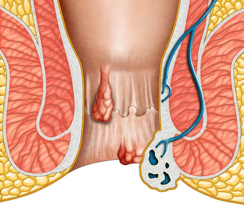 Bệnh trĩ: Dấu hiệu, phân loại và cách phòng ngừa hiệu quả 2