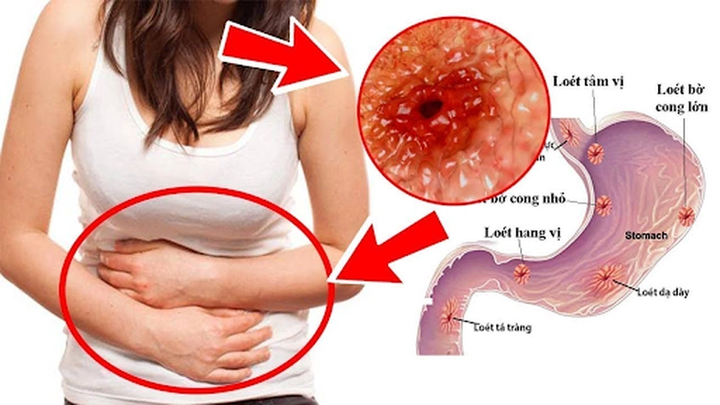 Đau dạ dày: nguyên nhân, hậu quả và cách khắc phục 1
