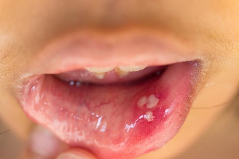 Virus HPV lây qua đường nào và có thể gây ra những bệnh gì?