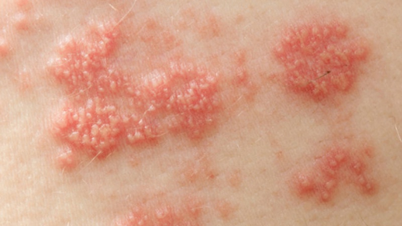 Virus HPV lây qua đường nào và có thể gây ra những bệnh gì? 1