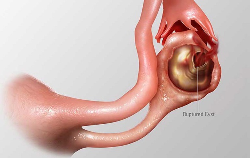 Biến chứng u nang buồng trứng bị vỡ có nguy hiểm không? 3