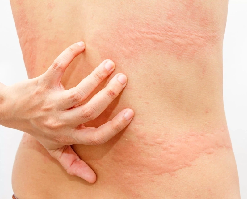 Vòng đời của sán lá gan có đặc điểm gì? Triệu chứng khi nhiễm sán lá gan2