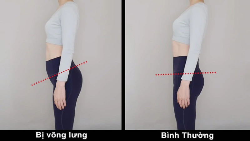 Có nhiều nguyên nhân gây ra võng lưng