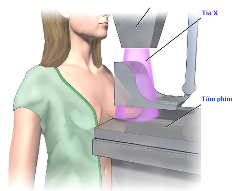 Ung thư biểu mô ống tuyến vú tại chỗ (Nội ống) (DCIS)2