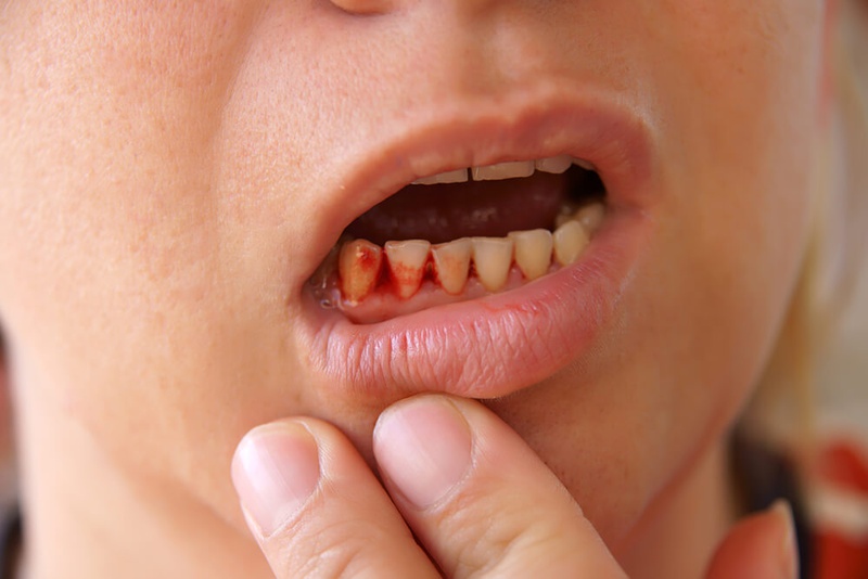 Phải làm gì khi viêm lợi chảy máu chân răng 1