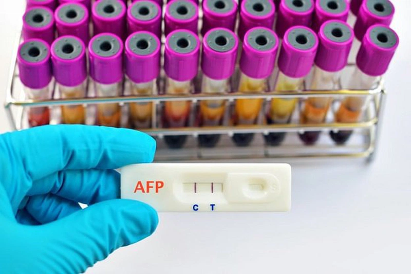 Xét nghiệm AFP là gì là thắc mắc của nhiều người