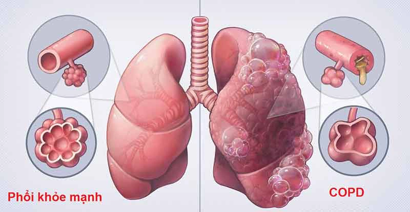 COPD dự kiến ​​sẽ trở thành nguyên nhân tử vong thứ ba trên toàn thế giới vào năm 2030