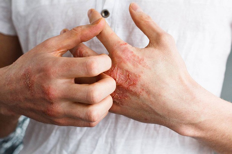Bệnh giang mai nguy hiểm và có thể lây lan qua quan hệ tình dục không an toàn