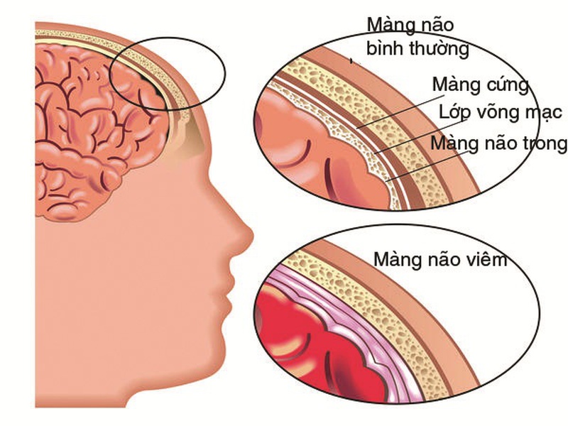 Xét nghiệm kháng thể thủy đậu như thế nào2