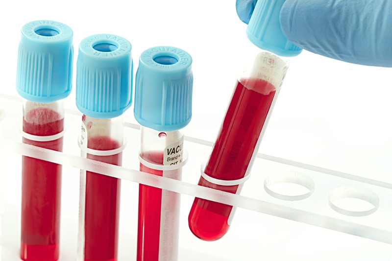 Xét nghiệm máu có mấy loại cơ bản?3