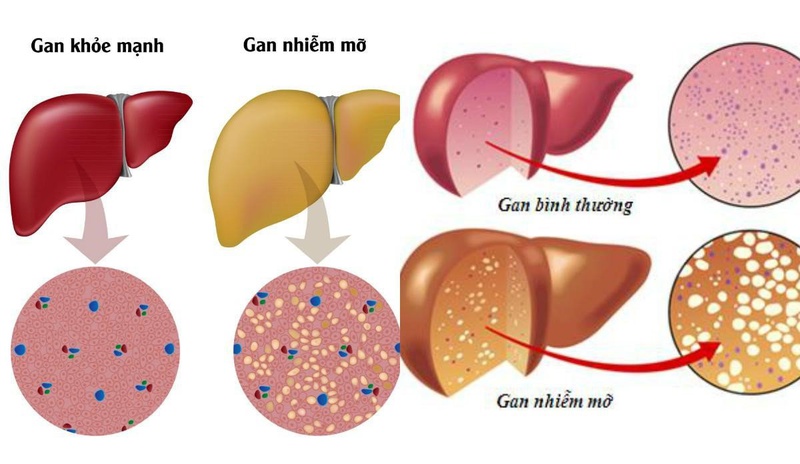 Xét nghiệm nhóm máu có cần nhịn ăn không?3
