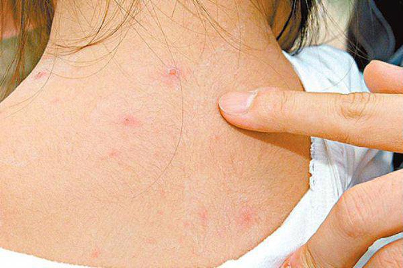 Xét nghiệm thủy đậu ở đâu và phương pháp thực hiện 1