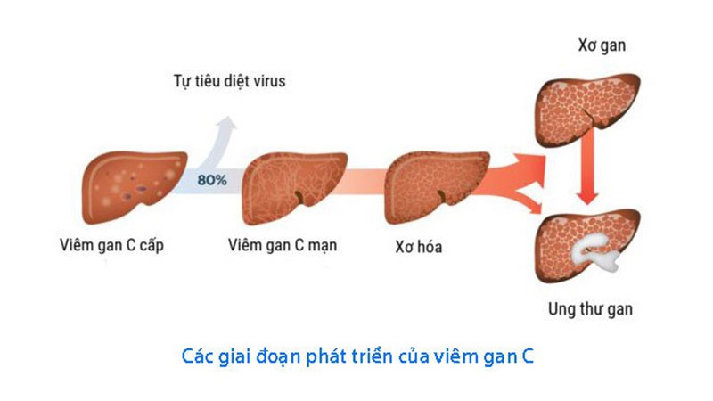 Tiến triển của bệnh viêm gan C rất âm thầm nên khá khó nhận biết