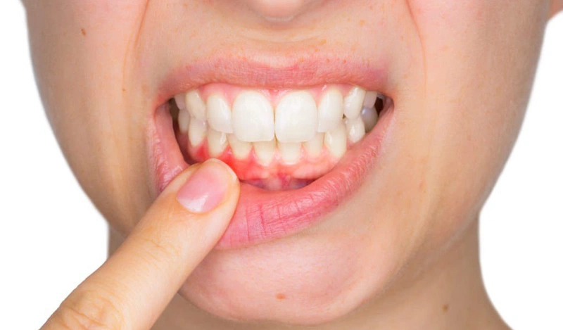 Chảy máu chân răng là bệnh lý gây tổn thương răng