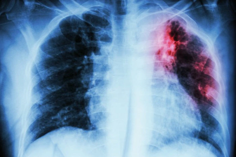 Xơ phổi là bệnh gì? Người bị xơ phổi có lây không? 2