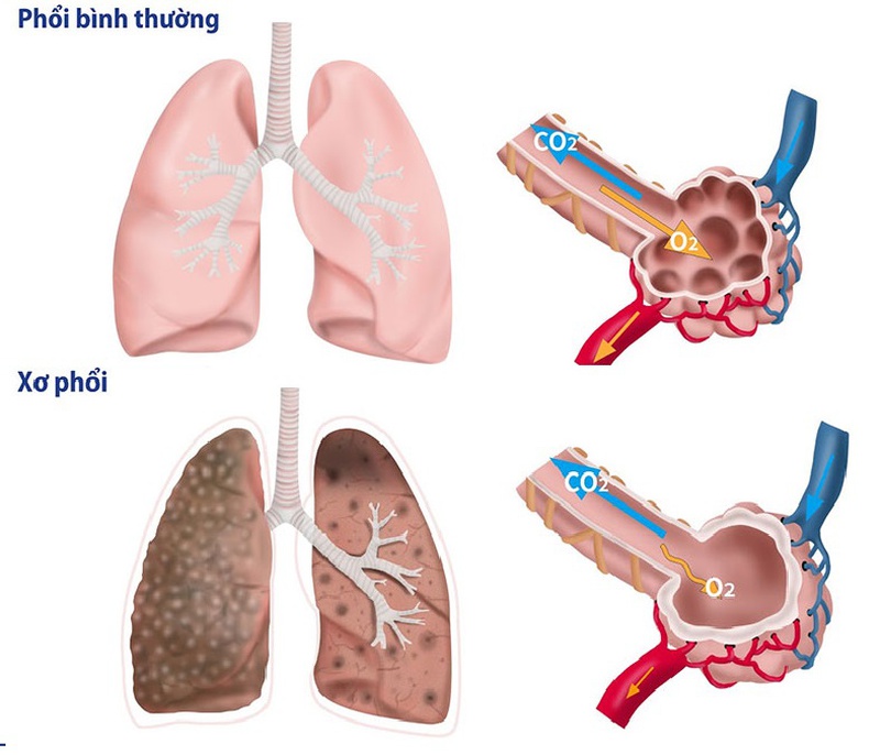 Xơ phổi vô căn là gì? Nguyên nhân, dấu hiệu và cách nhận biết 1