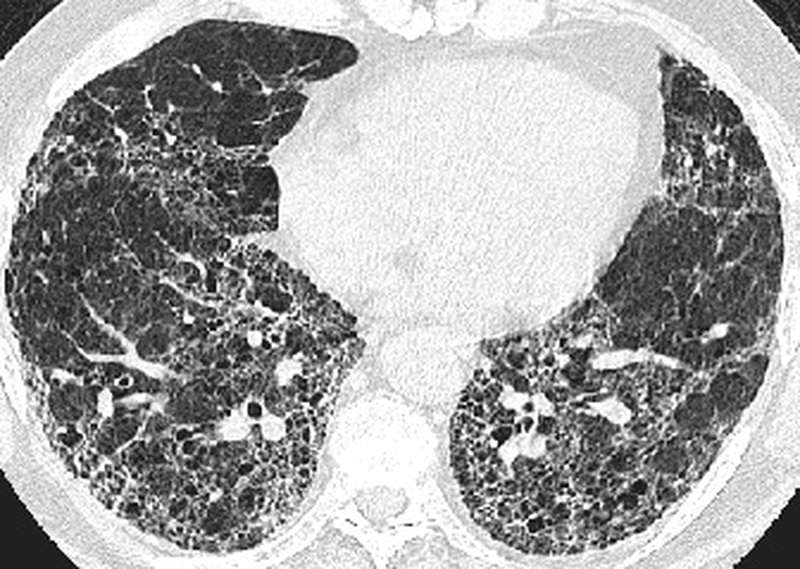 Xơ phổi vô căn là gì? Nguyên nhân, dấu hiệu và cách nhận biết 2