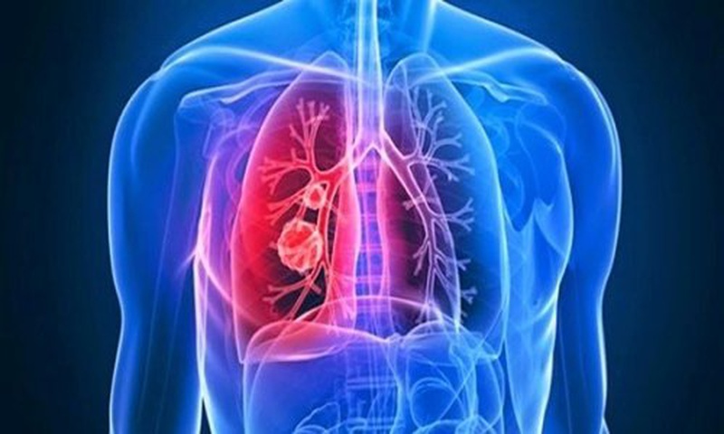 Xơ phổi vô căn là gì? Nguyên nhân, dấu hiệu và cách nhận biết 3