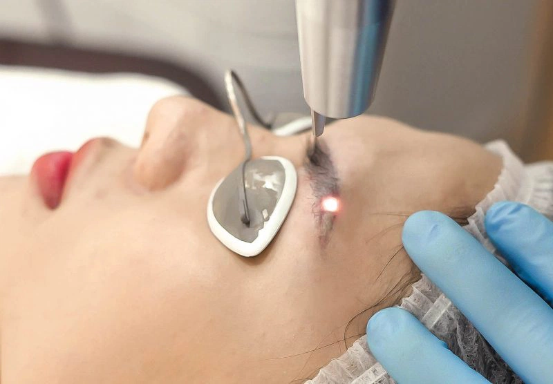 Giải đáp: Xóa xăm lông mày có bị rụng lông không? 1