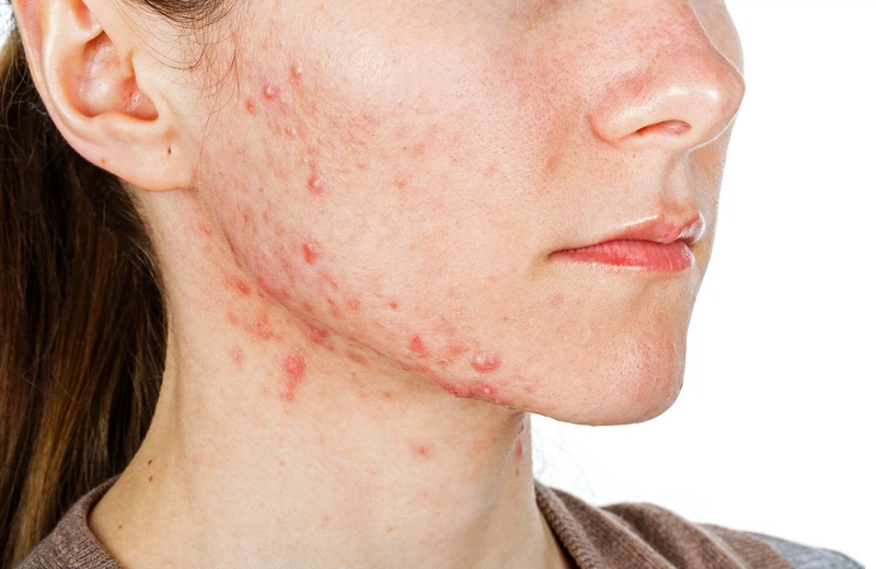 Xông mặt bằng vỏ bưởi có tác dụng gì 2