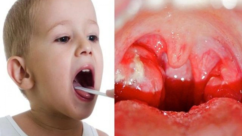 Xông mũi cho bé bằng nước muối sinh lý có thể giúp giảm đau họng cho bé