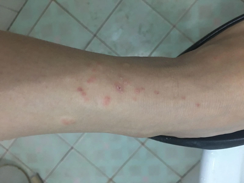 Xử lý khi bị sứa cắn như thế nào? 2