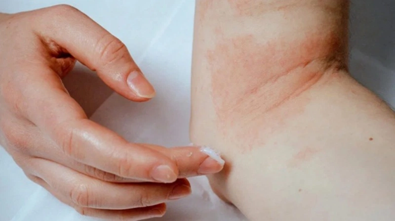 Xử lý khi bị sứa cắn như thế nào? 3