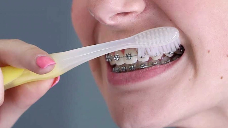 Xử lý sự cố dây cung tuột khỏi mắc cài khi niềng răng như thế nào? 2