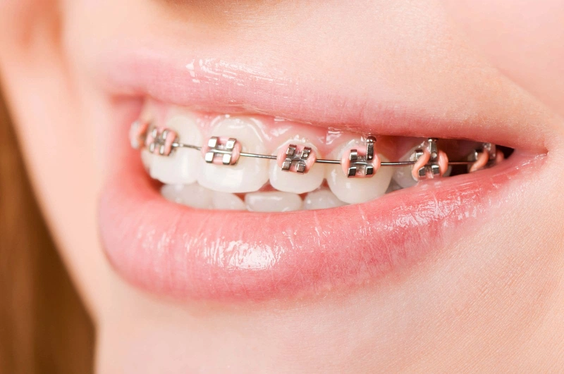 Xử lý sự cố dây cung tuột khỏi mắc cài khi niềng răng như thế nào? 3