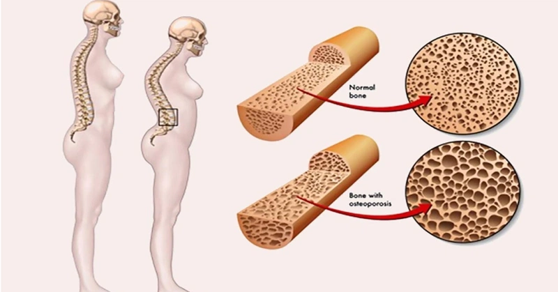 Đau khớp háng một bên trái có nguy hiểm không 2