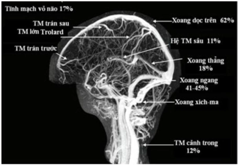 Ý nghĩa của chụp MRA cộng hưởng từ mạch máu-1