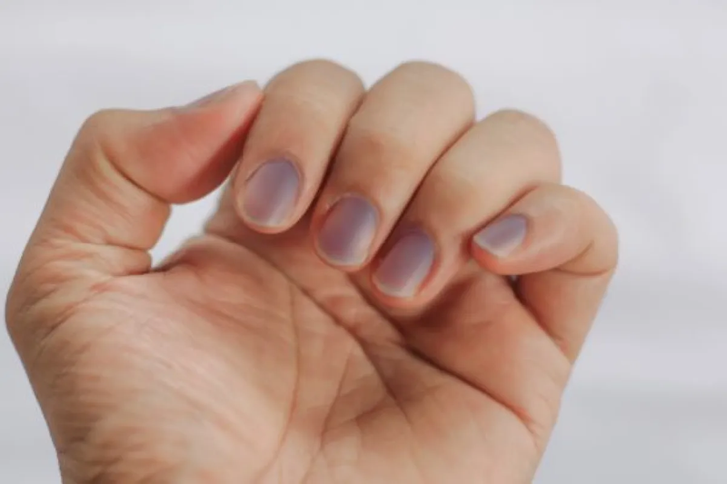 Các bệnh về móng tay phổ biến bạn không nên xem thường