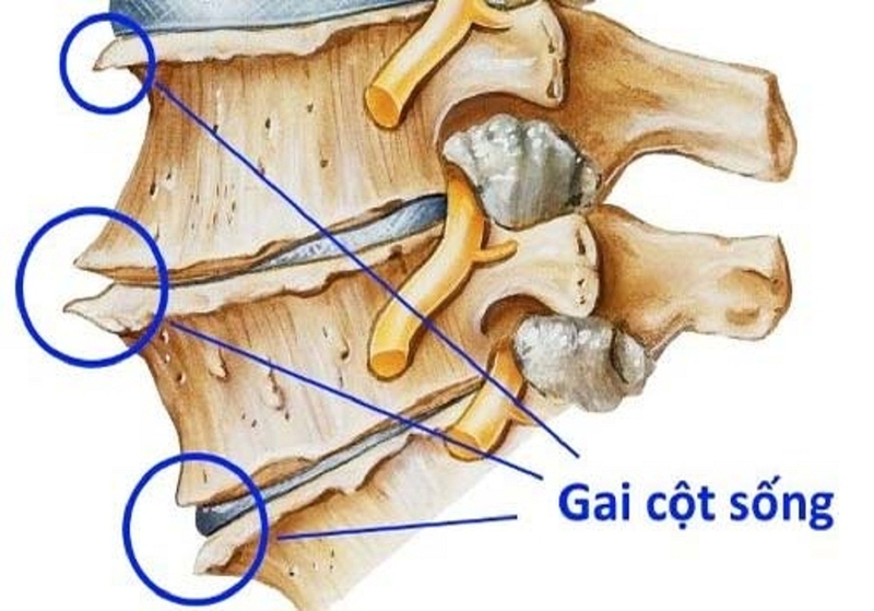 Gai cột sống ăn gì để hỗ trợ điều trị bệnh tốt nhất 1