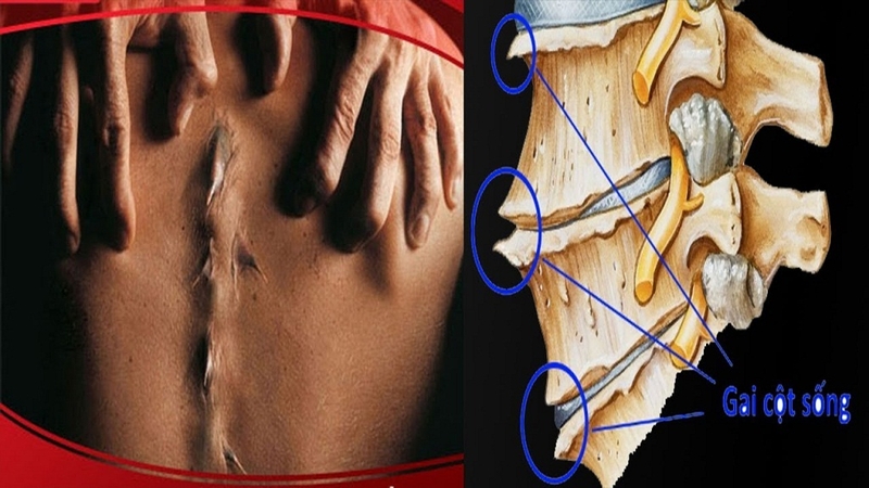 Gai cột sống uống cây gì để nhanh chóng đẩy lùi các cơn đau nhức1