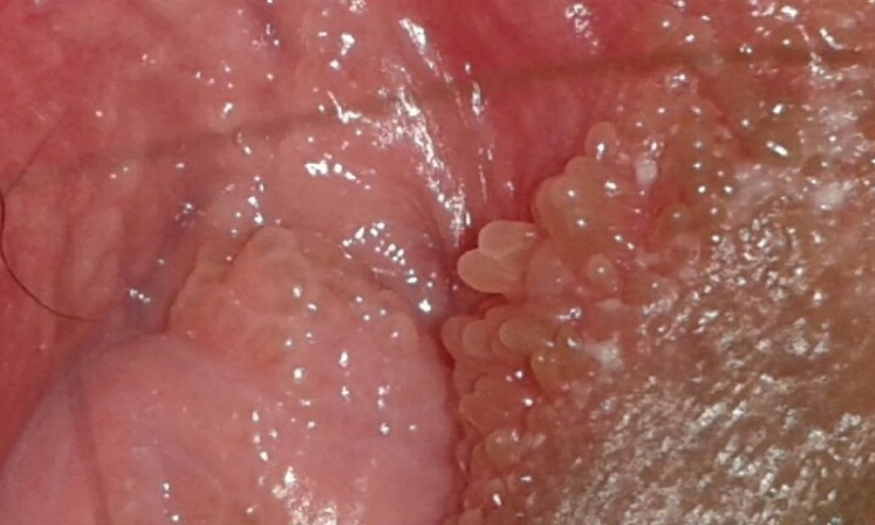 gai sinh dục nữ xuất hiện khi nào